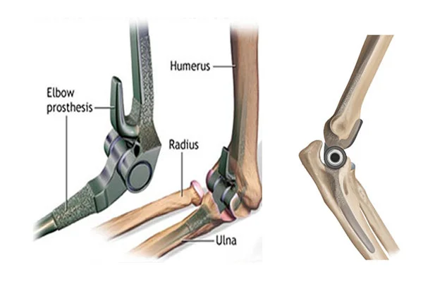 Glyra Orthopaedics