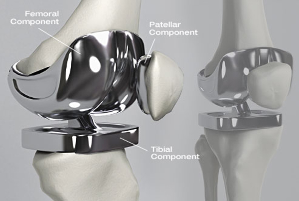 Knee Replacement