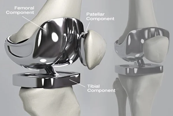Knee Replacement