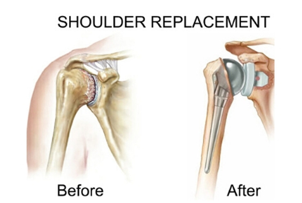Shoulder Replacement