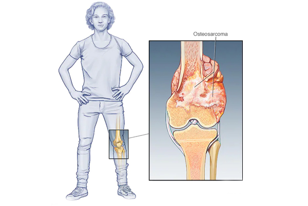Bone Tumor Surgery