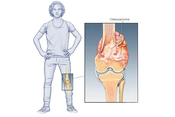 Bone Tumor Surgery