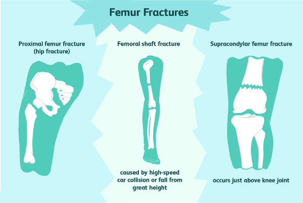 Fracture Management