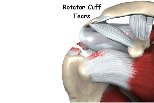 Rotator Cuff Tears