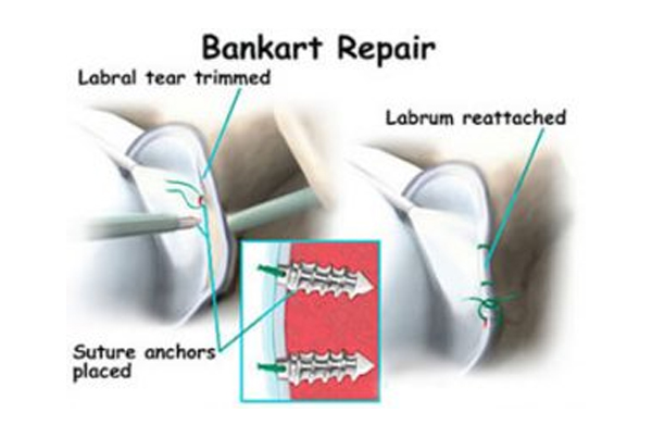 Bankart Lesion