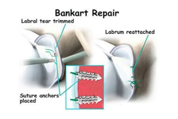 Bankart Lesion