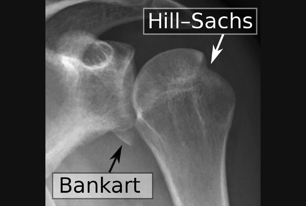 A Hill Sachs Lesion