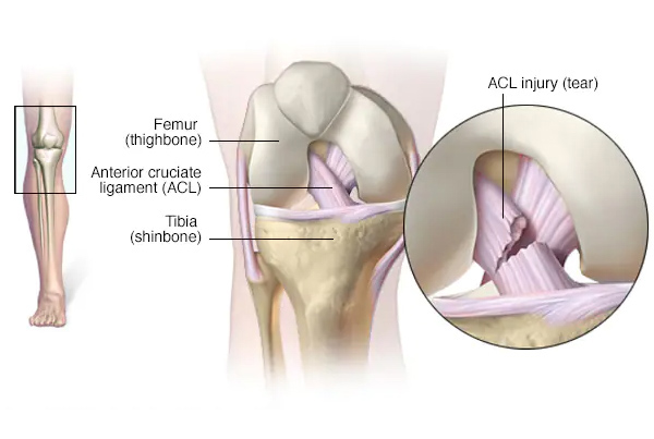 ACL