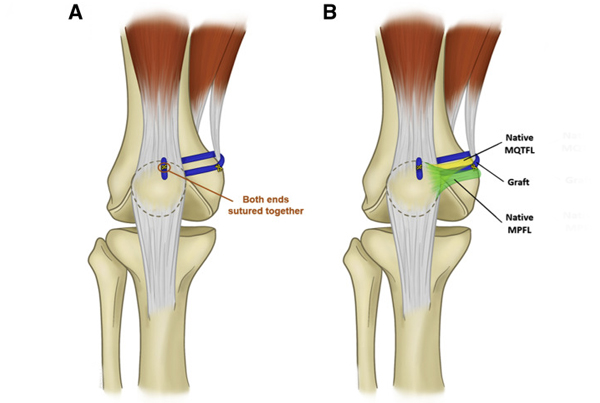 MPFL Injuries